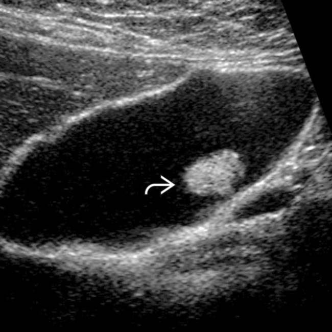 لحمية المرارة (Gallbladder Polyps): متى تكون حميدة ومتى تستدعي استئصال المرارة؟